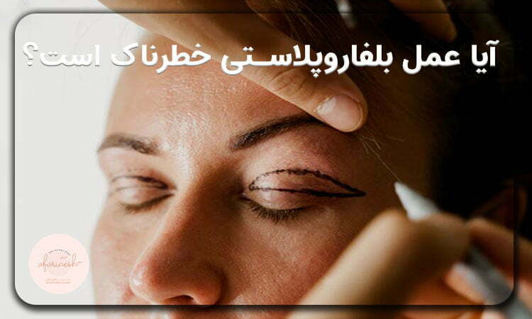 آیا عمل بلفاروپلاستی خطرناک است؟