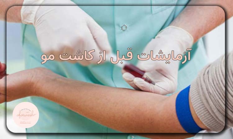 آزمایشات قبل از کاشت مو