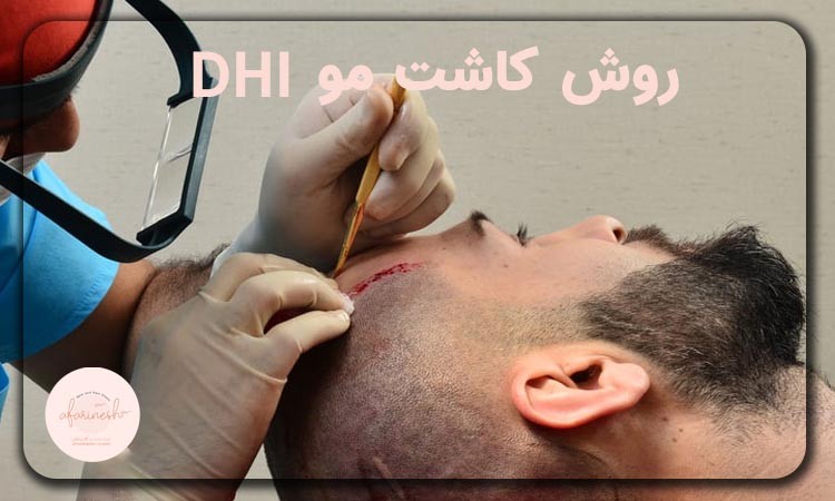 کاشت مو DHI