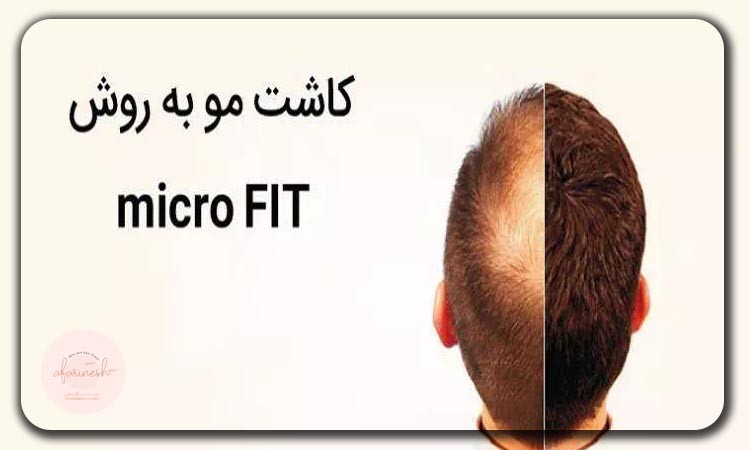 کاشت مو Micro FIT