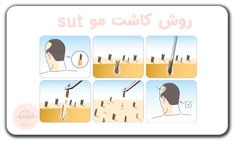 کاشت مو SUT