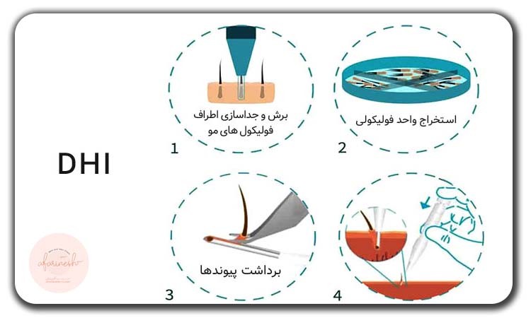 مراحل کاشت مو به روش dhi