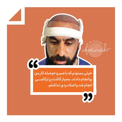 نظرات کسانی که کاشت مو انجام داده اند