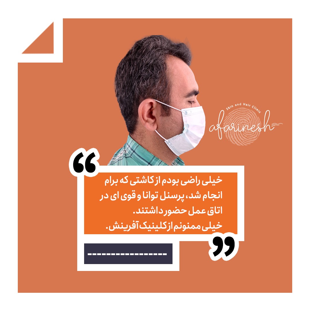 نظرات کسانی که کاشت مو داشته اند