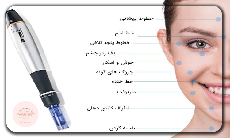 نقاط مناسب برای میکرونیدلینگ