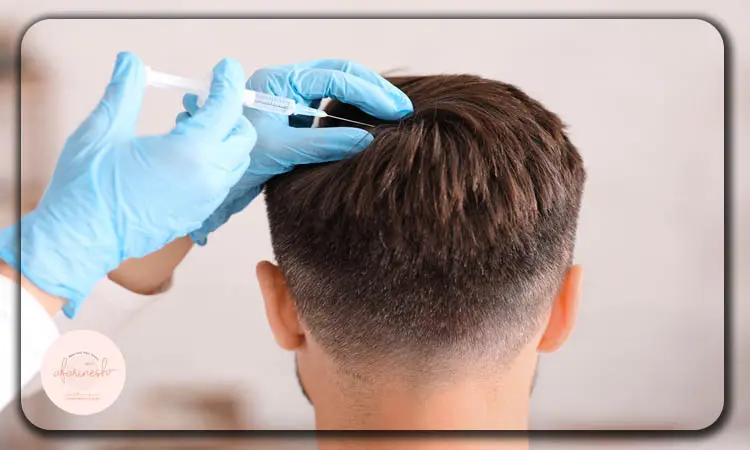 تاثیر مزوتراپی بعد از کاشت مو