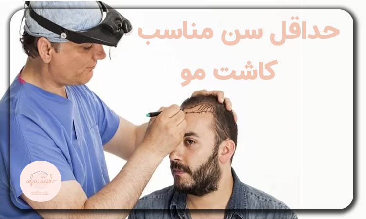 حداقل سن مناسب کاشت مو چقدر است؟