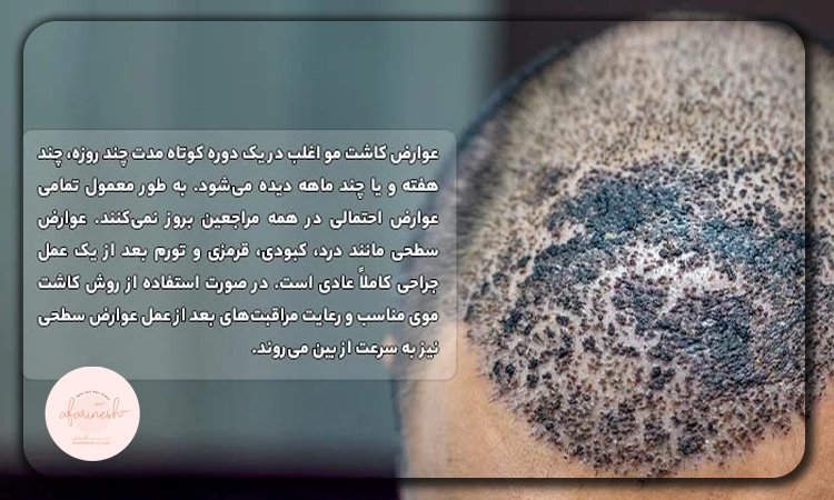 عوارض شایع کاشت مو
