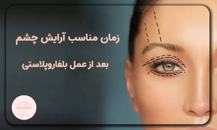 زمان مناسب آرایش چشم بعد عمل بلفاروپلاستی