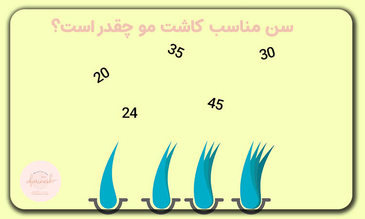 سن کاشت مو