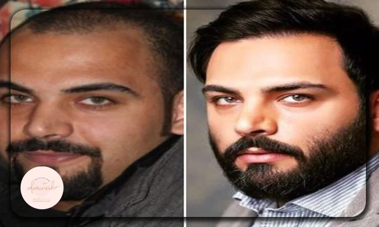 عکس کاشت مو احسان علیخانی قبل و بعد