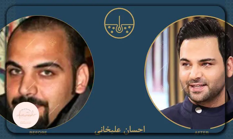 احسان علیخانی قبل از کاشت مو