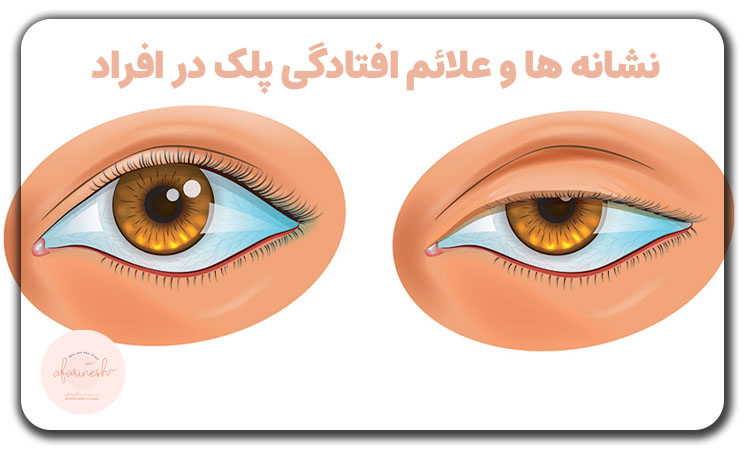علائم افتادگی پلک در افراد