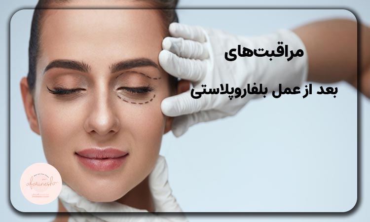 مراقبتهای بعد عمل بلفاروپلاستی