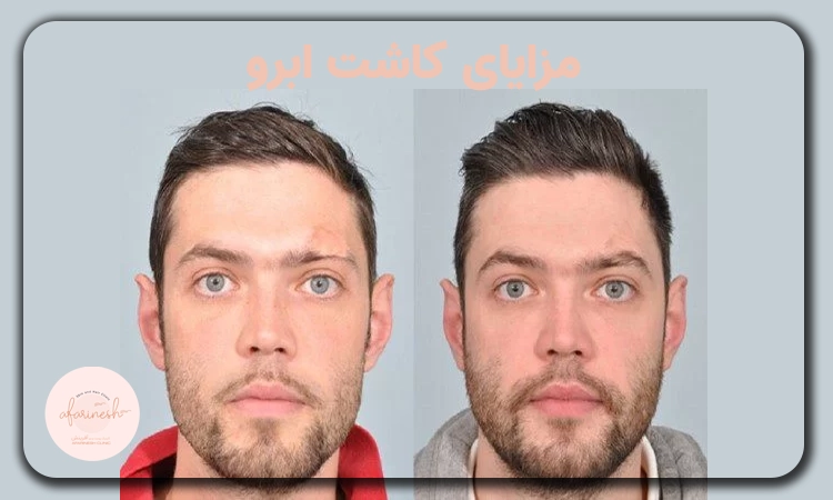 مزایای کاشت ابرو