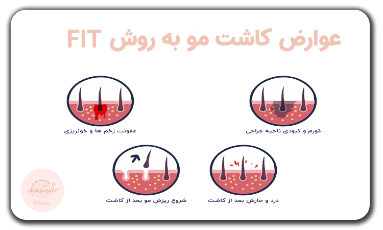 عوارض کاشت مو FIT
