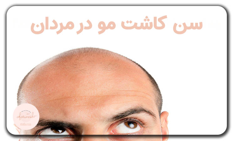 سن کاشت مو مردان