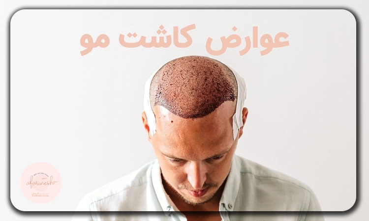 عوارض کاشت مو چیست؟