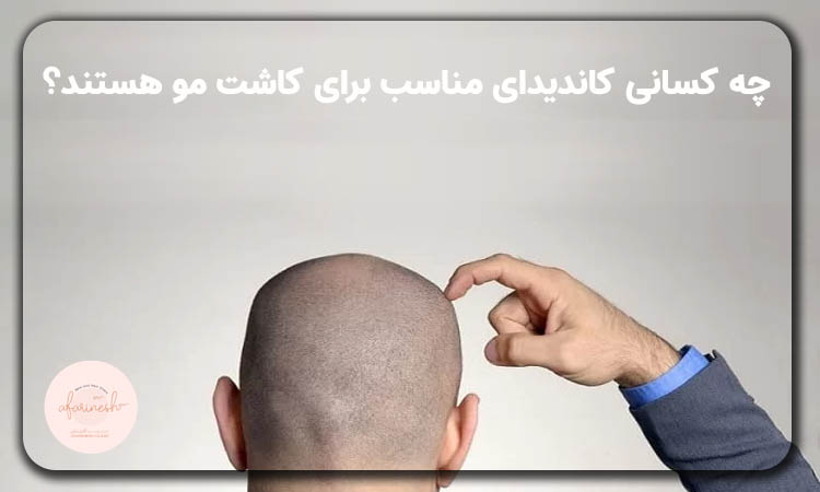 کاندیدای کاشت مو