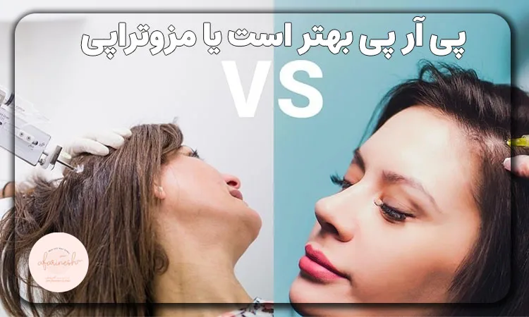 پی آر پی بهتر است یا مزوتراپی