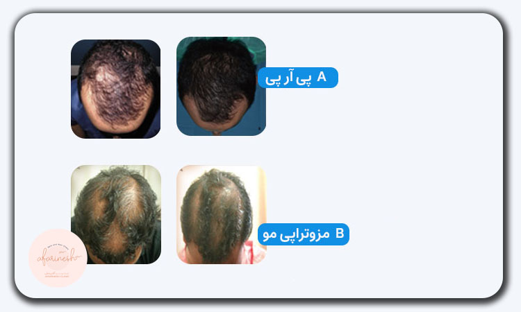 بعد از کاشت مو پی آر پی بهتره یا مزوتراپی