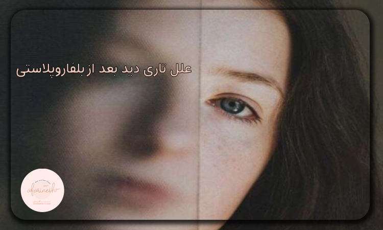 علت تاری دید بعد از بلفاروپلاستی