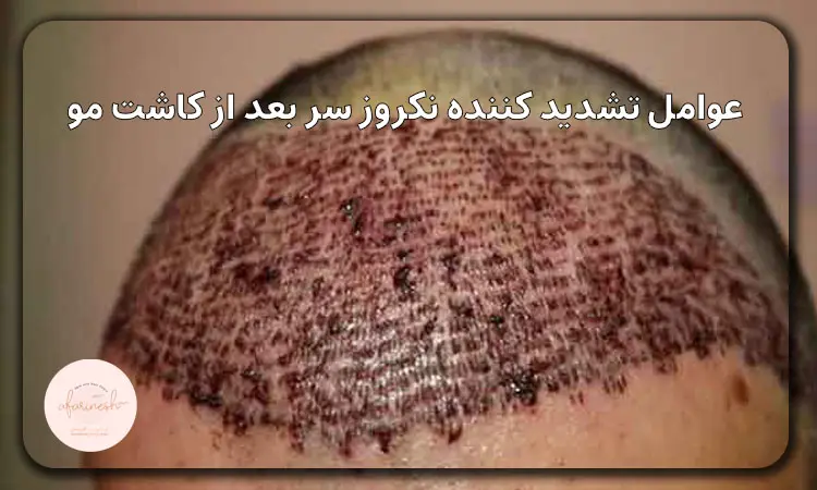 عوامل تشدید کننده نکروز سر