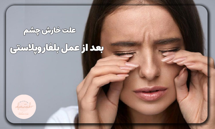 علت خارش چشم بعد از عمل بلفاروپلاستی