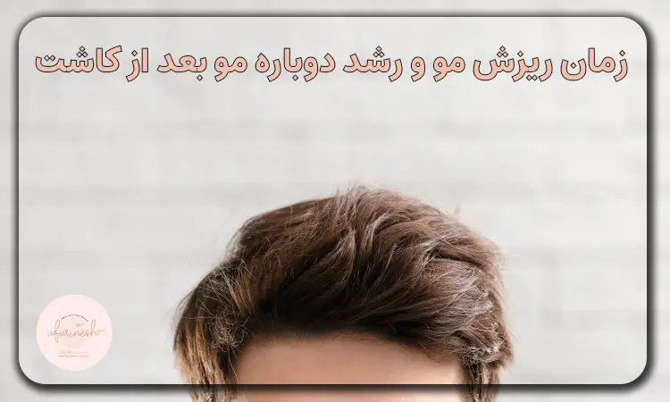 زمان ریزش و رویش دوباره مو بعد از کاشت