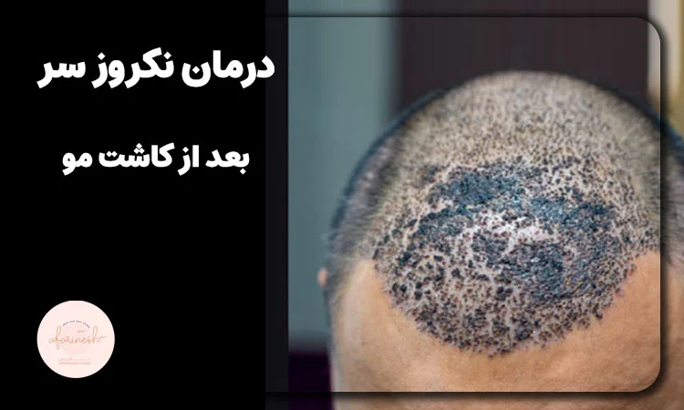 عکس نکروز کاشت مو