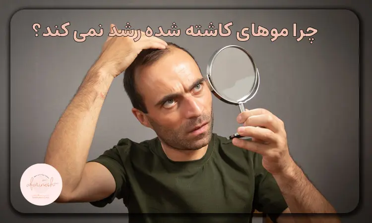 چرا موهای کاشته شده رشد نمی کند