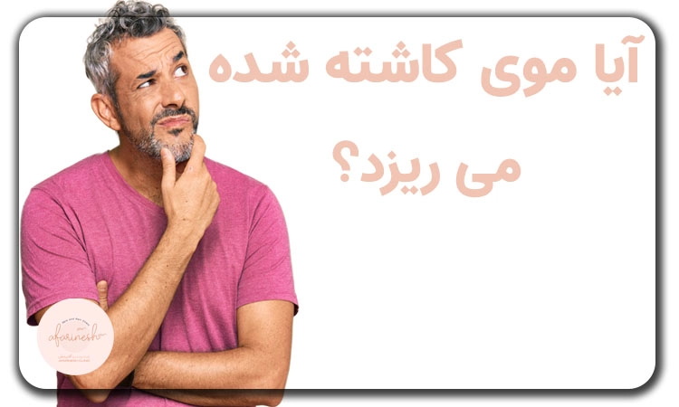 ریزش مو بعد از کاشت مو
