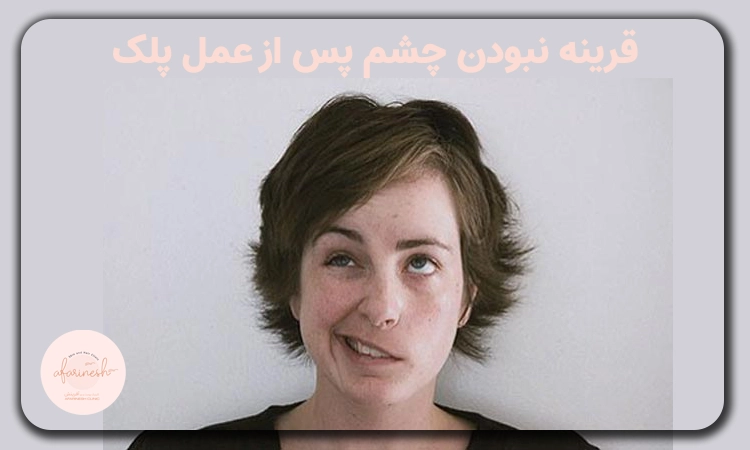 قرینه نبودن چشم بعد از عمل پلک