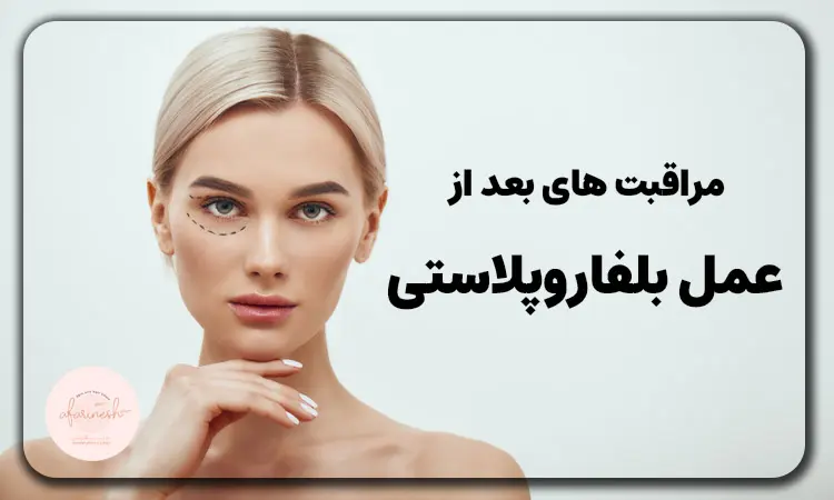 مراقبت های بعد از عمل بلفاروپلاستی