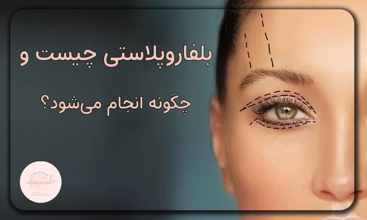 بلفاروپلاستی چیست و چگونه انجام می‌شود؟