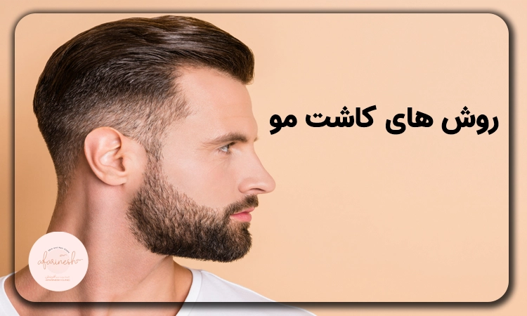 روشهای مختلف کاشت مو