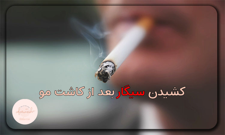 سیگار بعد از کاشت مو