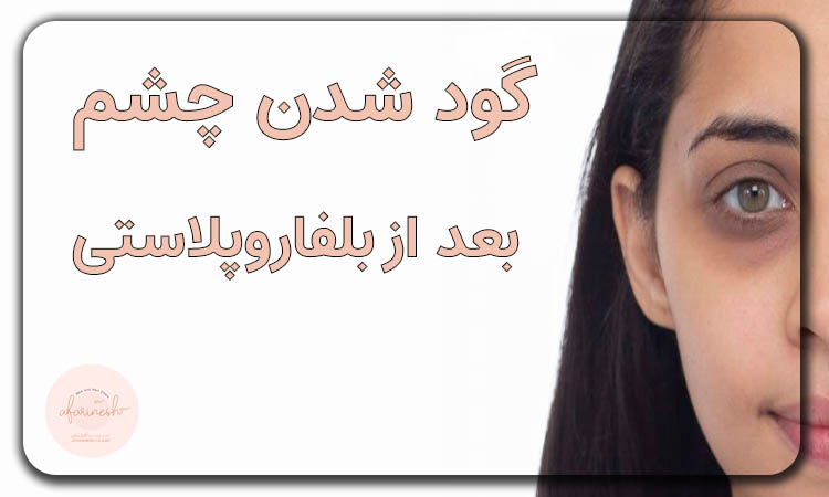 بلفاروپلاستی برای گودی چشم