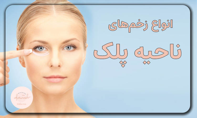زخم‌های ناحیه پلک