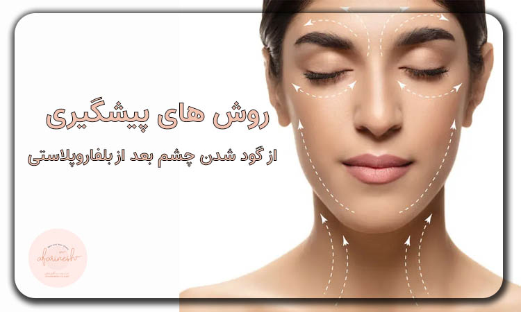 روش های برطرف کردن گودی چشم بعد بلفاروپلاستی