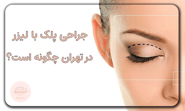 جراحی پلک با لیزر در تهران