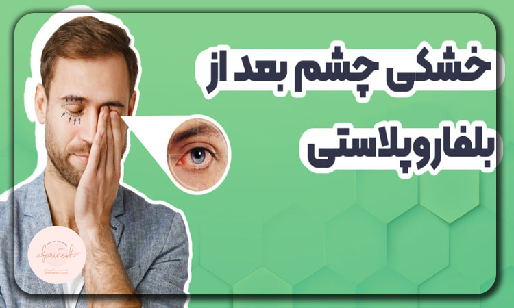 خشکی چشم بعد عمل بلفاروپلاستی