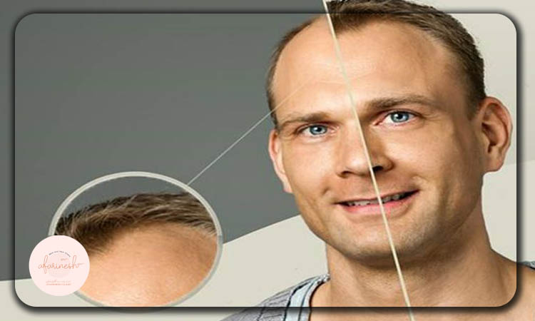 کاشت مو به روش سلول‌ بنیادی