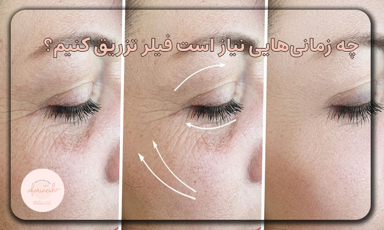 چه زمانی نیاز داریم فیلر تزریق کنیم؟