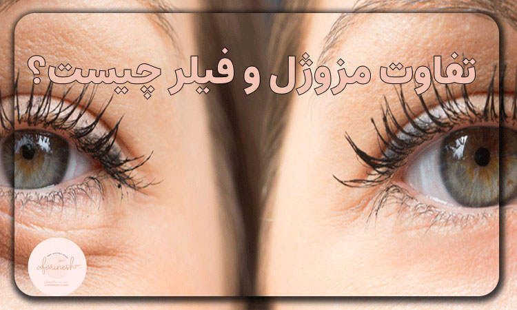 تفاوت مزوژل و فیلر چیست؟