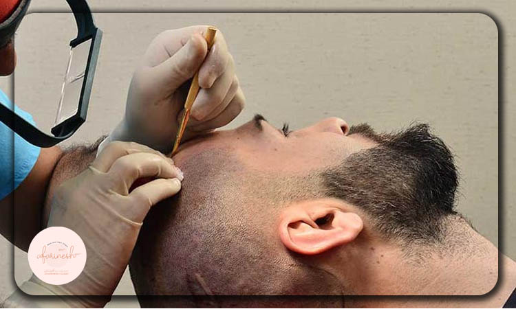 کاشت مو به روش ترکیبی