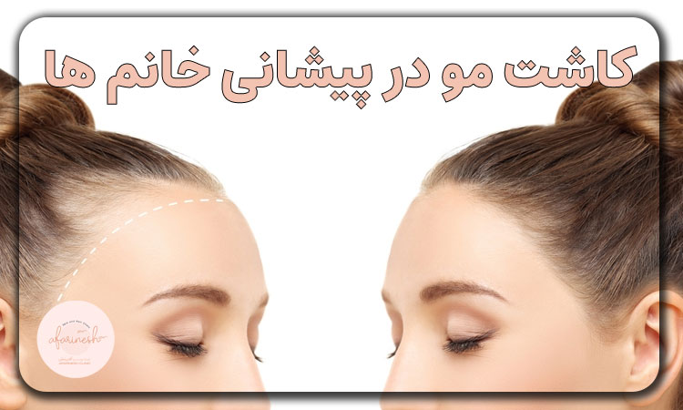 کاشت مو پیشانی زنان