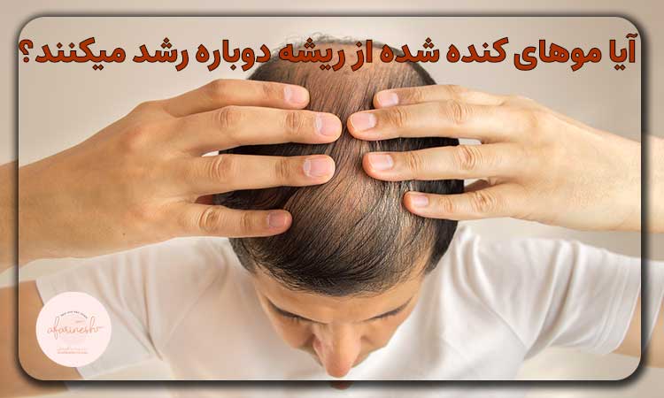 آیا موهای کنده شده از ریشه دوباره رشد میکنند؟
