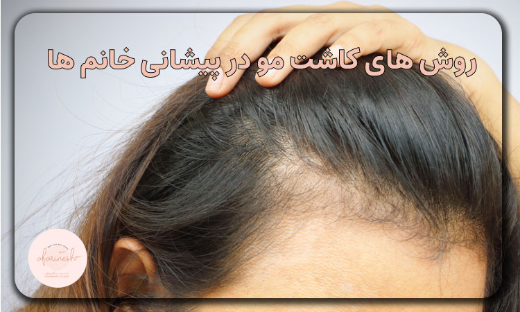 روش های کاشت مو در پیشانی خانم ها