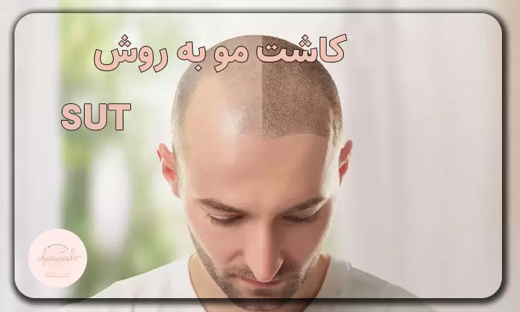 کاشت مو به روش SUT